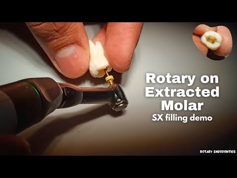 Rotary Filing (SX) on Molar | Some tips for doing Rotary Endodontics