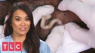 Dr. Lee Extracts Painful Cysts | Dr. Pimple Popper