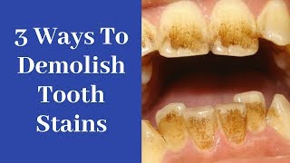 3 unusual hacks to Dramatically Remove Tooth Stains :0