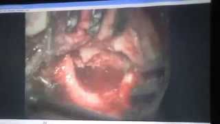 ENT - Dr.Nesem Tala't - Ear - Chronic otitis media - Part 2