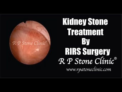 Kidney Stone Treatment by RIRS (Retrograde Intra Renal Surgery) 