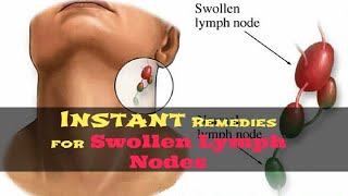How to Get Rid of Swollen Lymph Nodes Naturally | 5 Remedies for Swollen Lymph Nodes in Neck.
