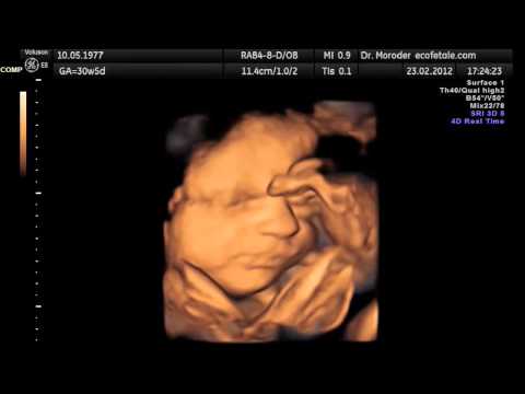 Fetuses Yawn in Utero