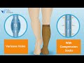 The Benefits Of Vein Compression Socks