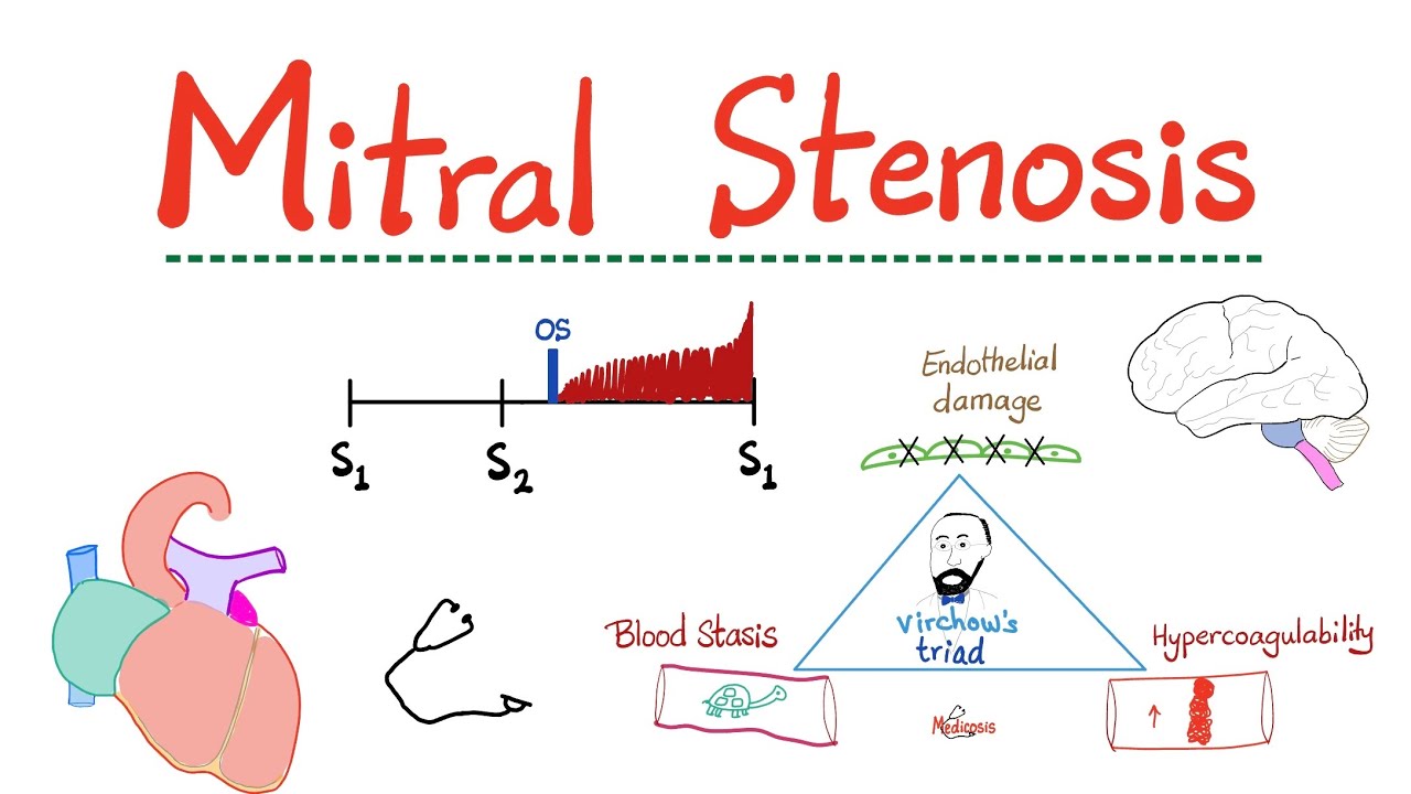Mitral Stenosis (MS) - Valvular Heart Disease (VHD) - Mitral Valve Stenosis - Cardiology Series