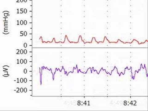Lipid Reversal of Bupivacaine Toxicity