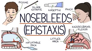 Understanding Nosebleeds (Epistaxis)