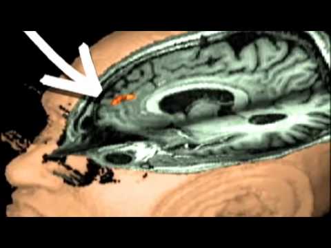 NOVA scienceNOW : 1 - Mirror Neurons