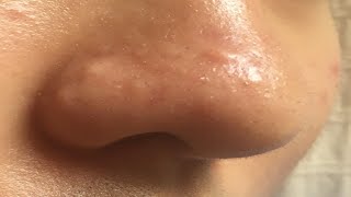 how to get rid of nose acne bumps easy