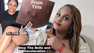 HOW TO PREVENT BOILS ON  THE INNER THIGHS, UNDERARM, BUTT|HAVE A SPOTLESS SKIN