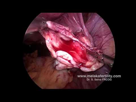 Single incision laparoscopic cystectomy