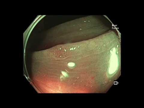 Colonoscopy: Subtle Polyp - Descending Colon