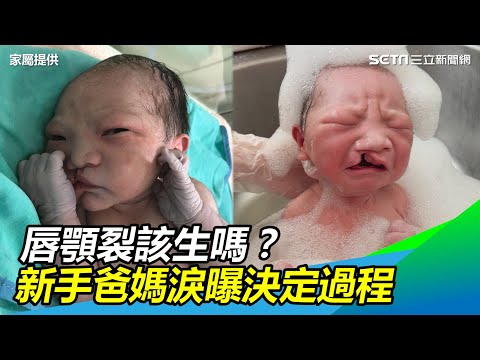 胎兒兔唇