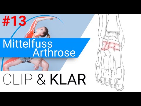 Mittelfuss Arthrose erklärt - Verschleiss im Kuppelbau