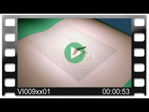 DynaMesh®-CICAT - Animation: MILOS Technique