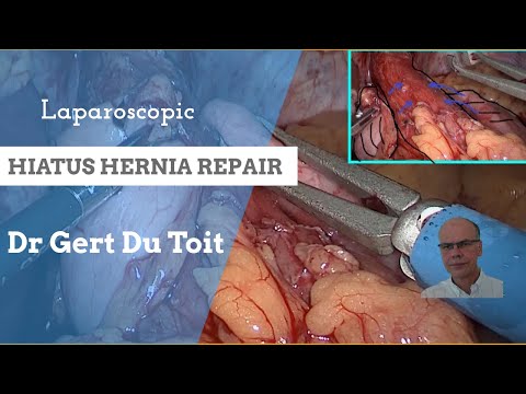 Laparoscopic Hiatus Hernia repair