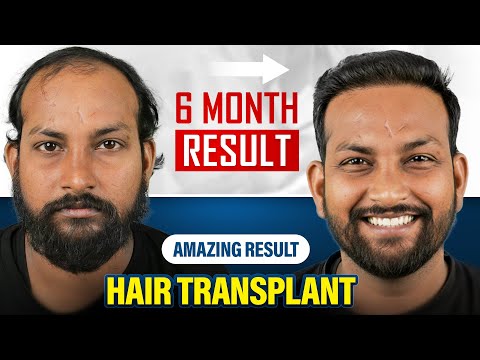 Advanced Hair Loss Case Solved