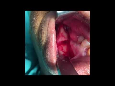 Mandible Fracture Treatment