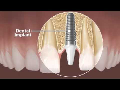 download lagu mp3 mp4 Ukraine Dental Implants, download lagu Ukraine Dental Implants gratis, unduh video klip Ukraine Dental Implants