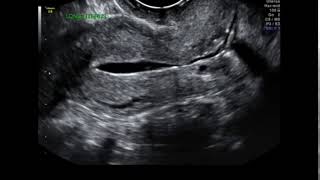 Sonohysterogram