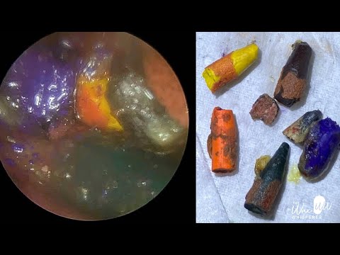 1,520 - FIVE SHARP-END CRAYON TIPS EXTRACTED FROM CHILD’S EAR!!
