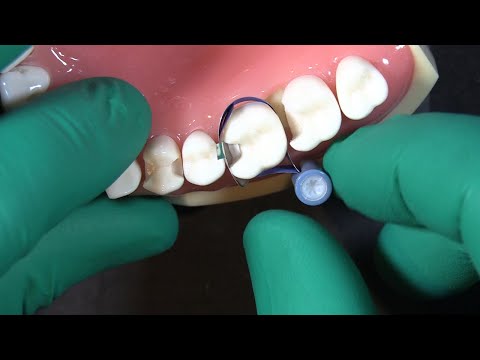 The Double Band Technique for Deep Margin Elevation (DME) | Dr. JD Corey