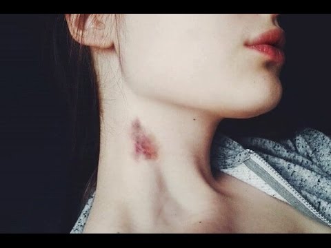 Девушки с веснушками по всему лицу Как избавиться от черных пигментных пятен на лице