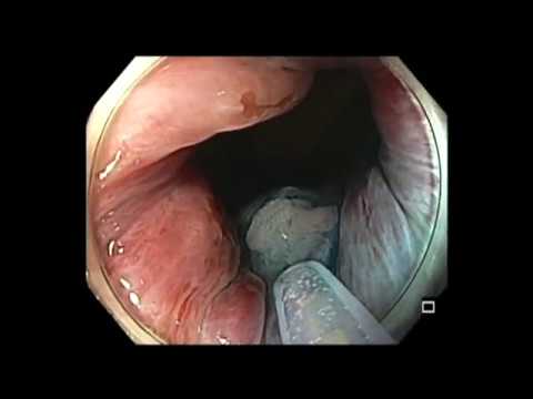 Colonoscopia - cáncer anal de células escamosas in situ RME