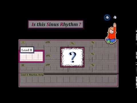 ECG Video-10 (Blog 113) - Rhythm Diagnosis: Part 1