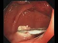 大腸鏡(colonoscopy) 大腸瘜肉切除1 #  Dr Ho Kai Tin # 何佳鈿醫生