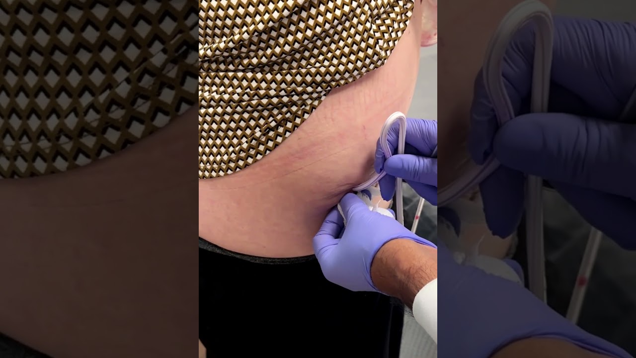 Surgical Drains Video Thumbnail