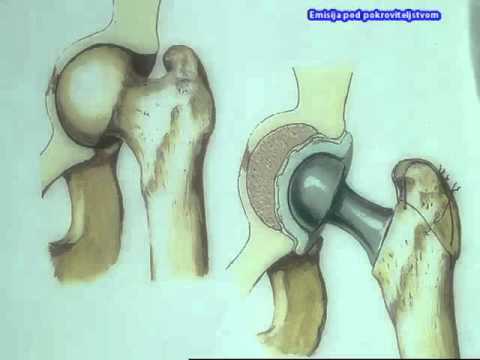 Bol u području zgloba kuka  (Zdrava logika)
