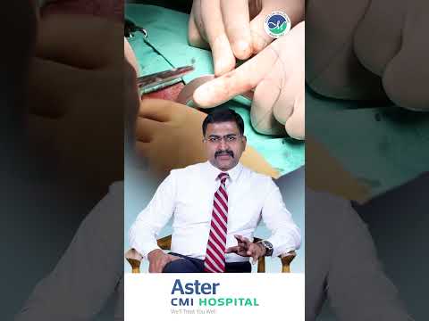 Treatment for Haemorrhoids | Dr. Mahesh Chikkachannappa | Aster CMI Hospital