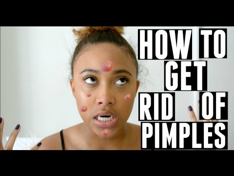 download lagu mp3 mp4 How To Get Rid Of Pimples Overnight Diy, download lagu How To Get Rid Of Pimples Overnight Diy gratis, unduh video klip How To Get Rid Of Pimples Overnight Diy