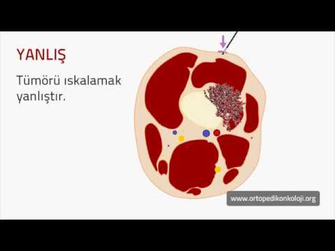 Biyopsi (OrtopedikOnkoloji.Org)