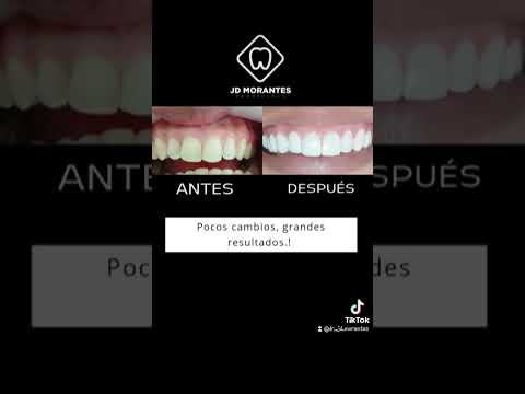 "¡Testimonio de transformación de sonrisa! 😁 #odontologia #saludbucal #blanqueamientodental #sonrie
