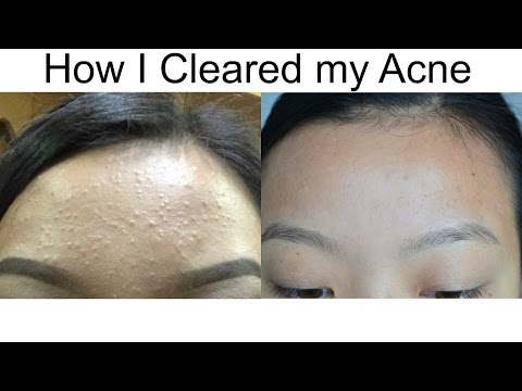 How I Cleared My Acne l (Baby Pimples)