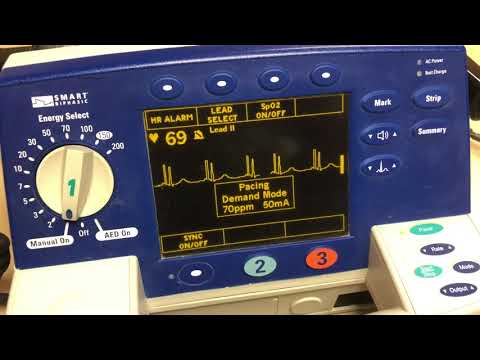Trancutaneously Pacing with the Philips Heartstart Monitor