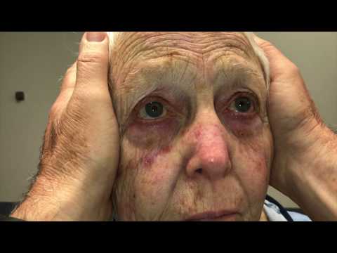 What does an abnormal head impulse test look like?