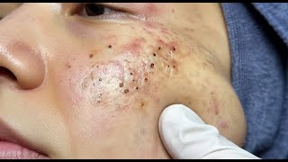 Loan Nguyen Acne Treatment 15m