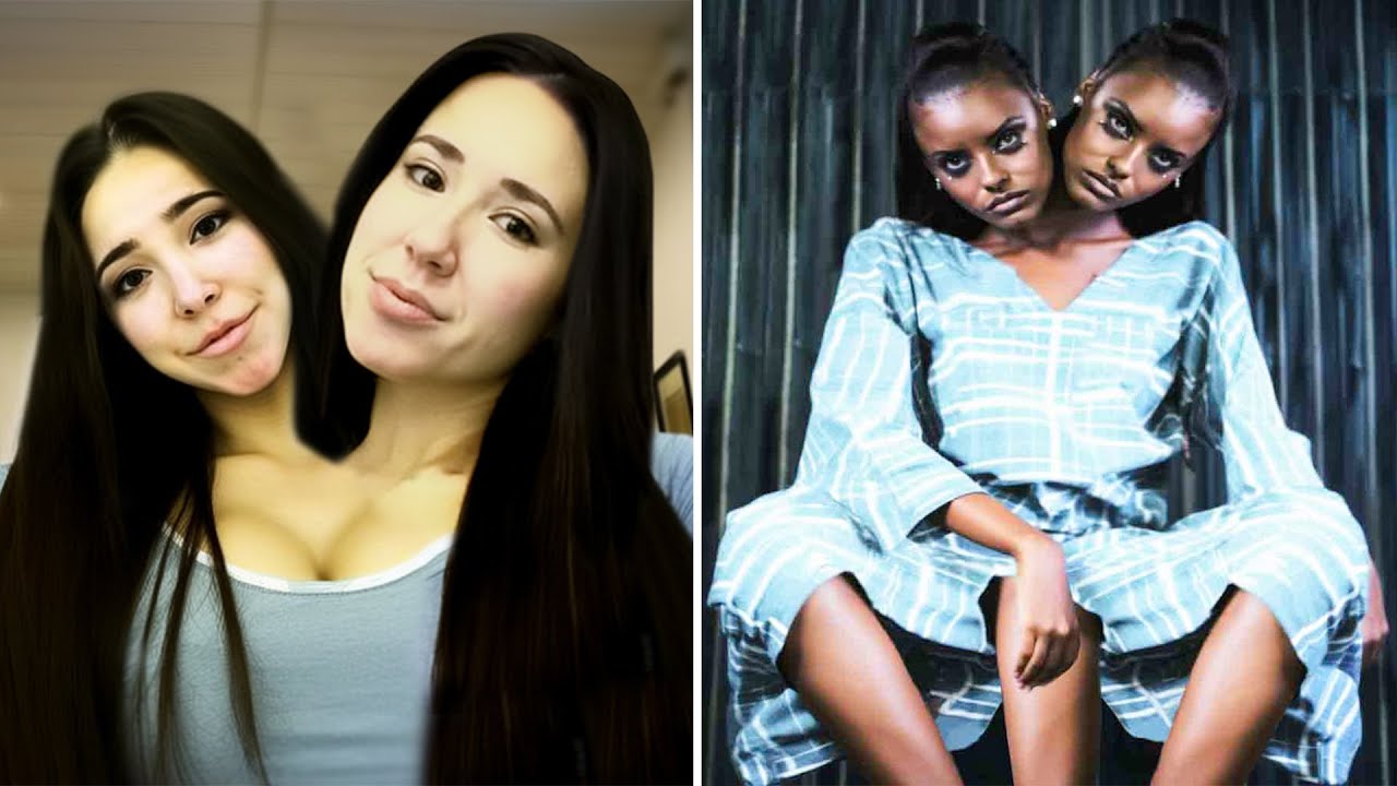 Discover the Unseen World of Siamese Twins: Top 15 Extraordinary Cases