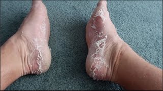 Watch Skin being peeled off of Feet after treatment