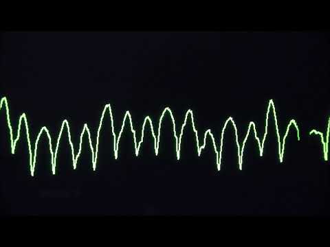 Cardiac arrest rhythms, VF, VT, Asystole and PEA