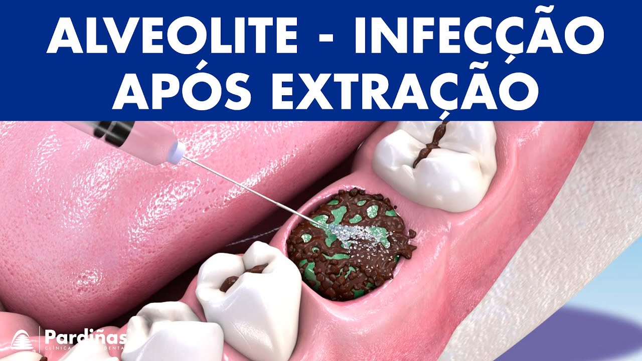 ALVEOLITE - Infecção após extração dente: causas e tratamento ©