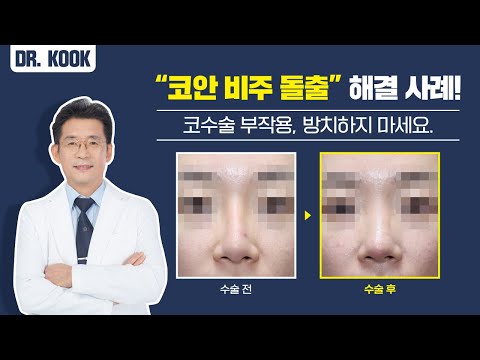 코성형수술 후 어마무시한 부작용 "코안 비주 돌출"의 원인과 재수술 사례 (With 그림 설명, 전후사진)