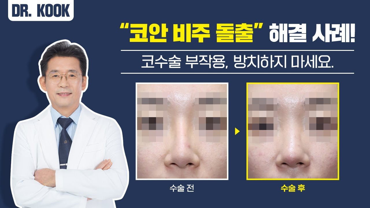 코성형수술 후 어마무시한 부작용 "코안 비주 돌출"의 원인과 재수술 사례 (With 그림 설명, 전후사진) 썸네일