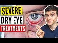 Severe Dry Eyes Treatment - Dry Eyes Treatment Guide