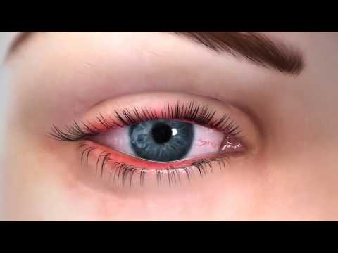 Beverly Hills Optometry - LipiFlow MGD Treatment (Dry Eye Therapy)