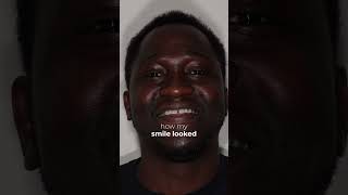 Smile Transformation
