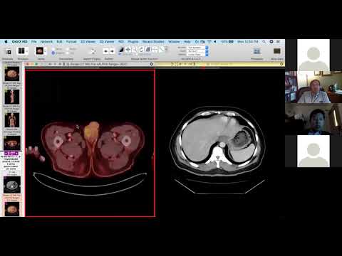 Subtle gastric cancer on CT - Dr. Nelly Tan